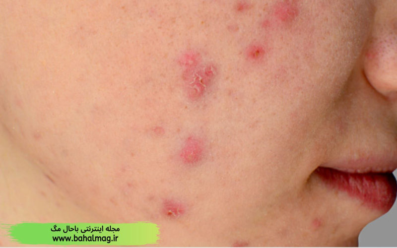 5 راه آسان برای رفع آثار آکنه