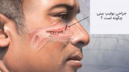 عمل پولیپ بینی با لیزر چگونه است