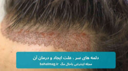 دلمه های روی سر
