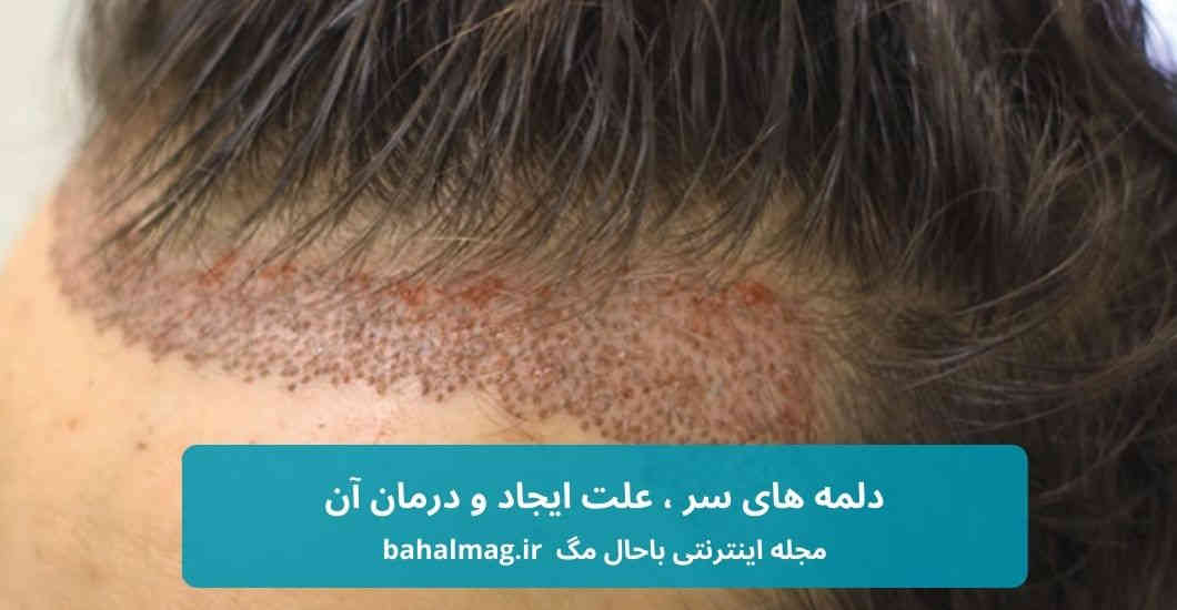 دلمه های روی سر