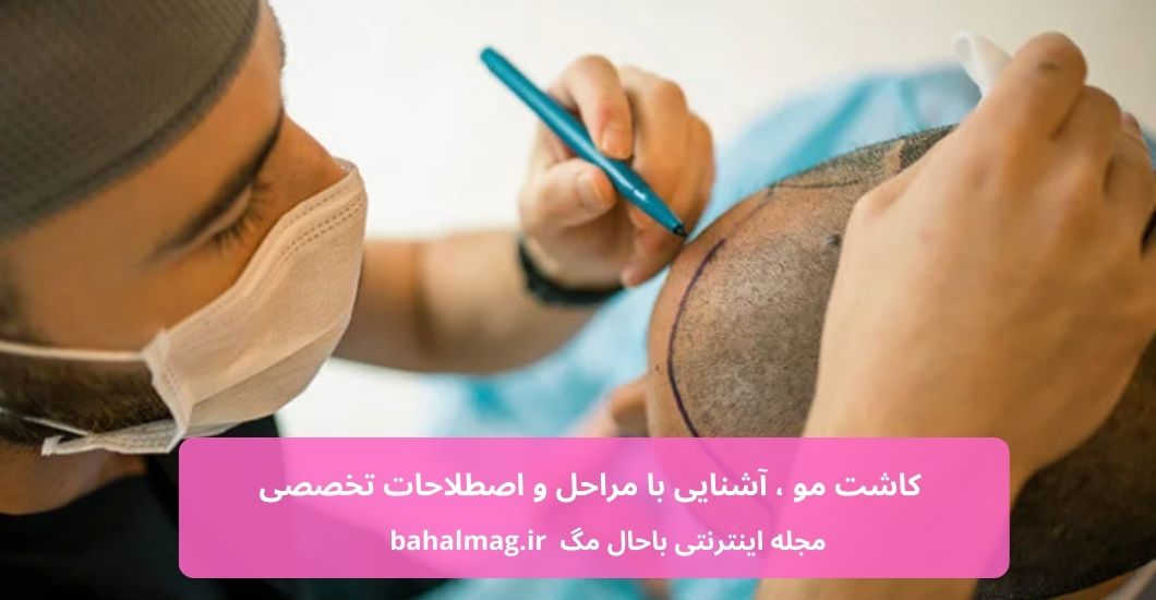 کاشت مو