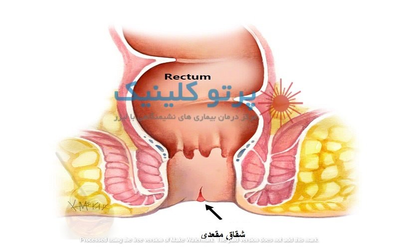 شقاق چیست و چگونه درمان می شود