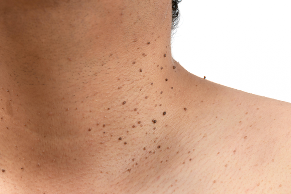 چگونه می توان یک زگیل را از خال گوشتی تشخیص داد؟