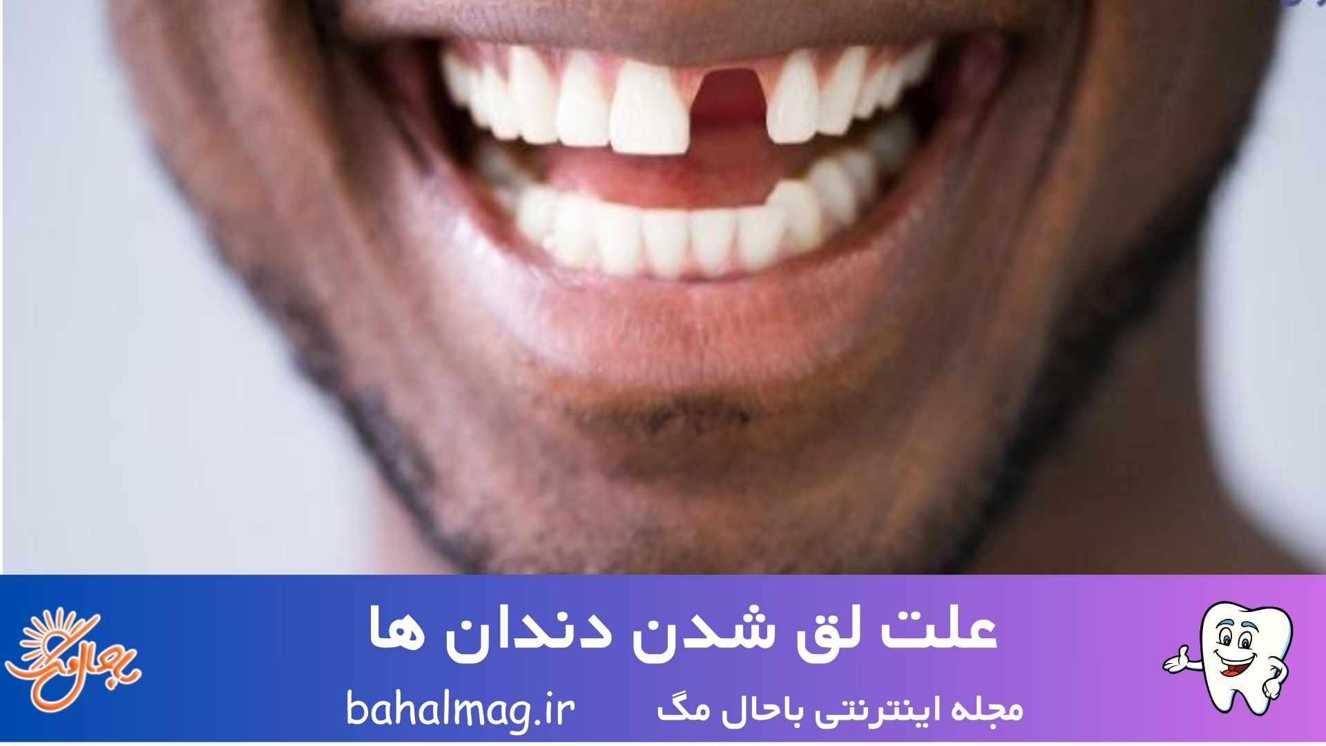 علت لق شدن دندان ها + راه های درمان لقی دندان