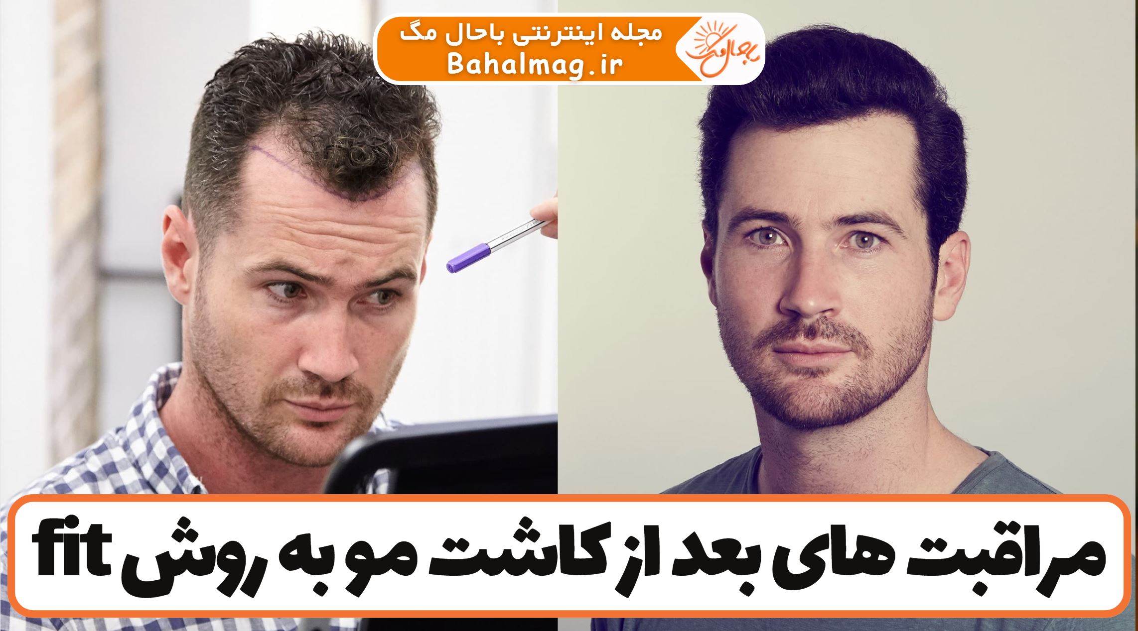 مراقبت های بعد از کاشت مو به روش fit