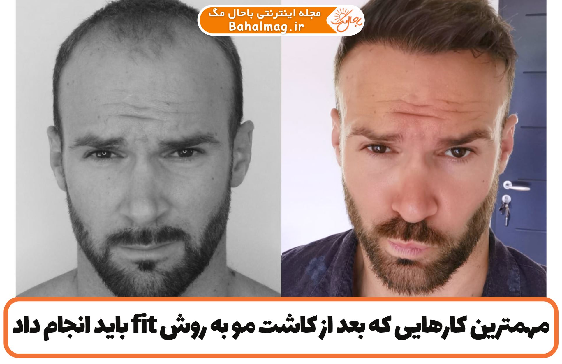 مهمترین کارهایی که بعد از کاشت مو به روش fit باید انجام داد
