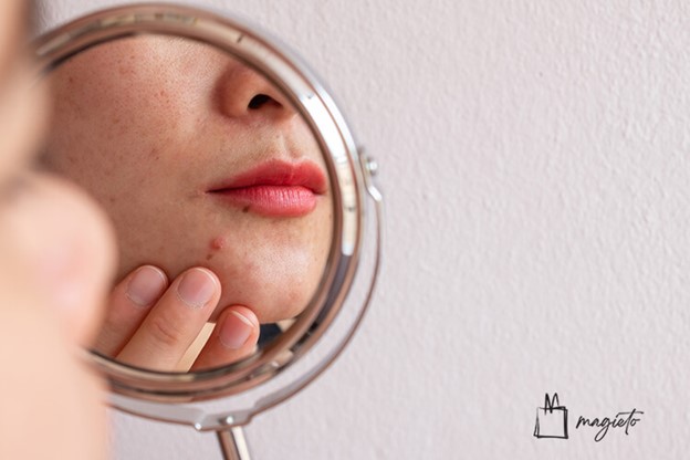 7 روش بی‌نظیر برای پیشگیری از جوش صورت