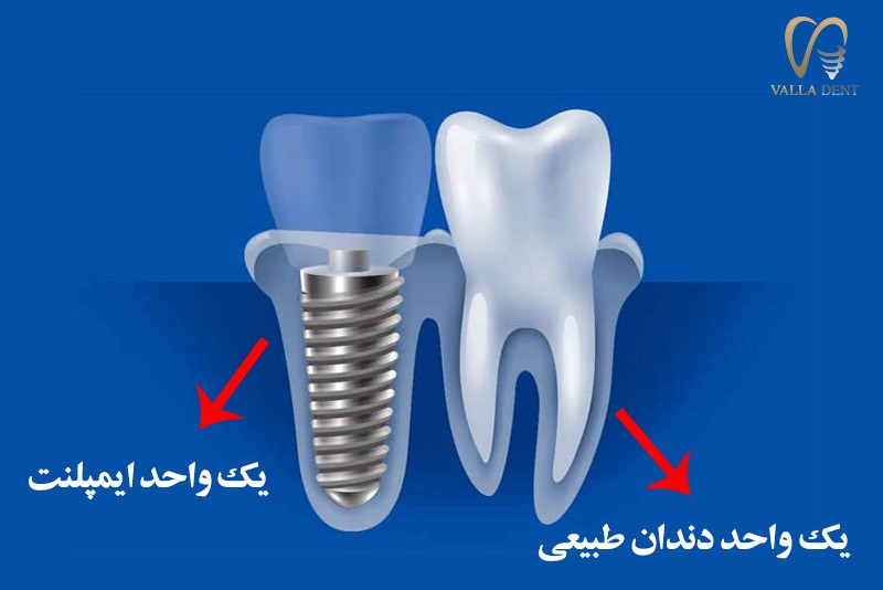 قیمت هر واحد ایمپلنت دندان
