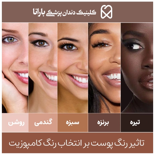 در انتخاب بهترین رنگ کامپوزیت دندان چه نکاتی باید در نظر گرفته شود