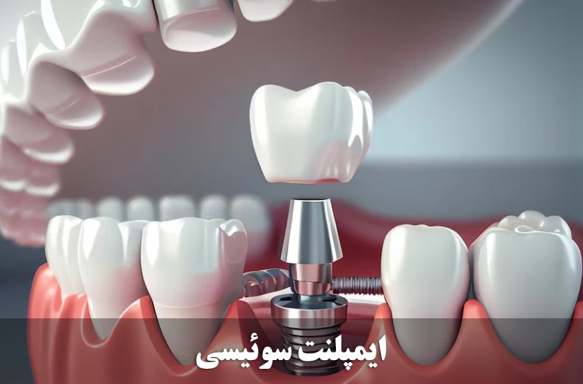 ایمپلنت سوئيسی