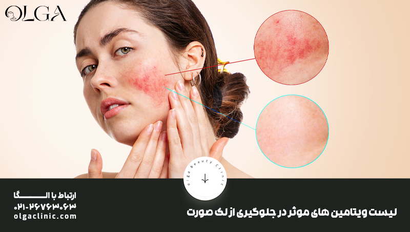 لیست ویتامین های موثر در جلوگیری از لک صورت