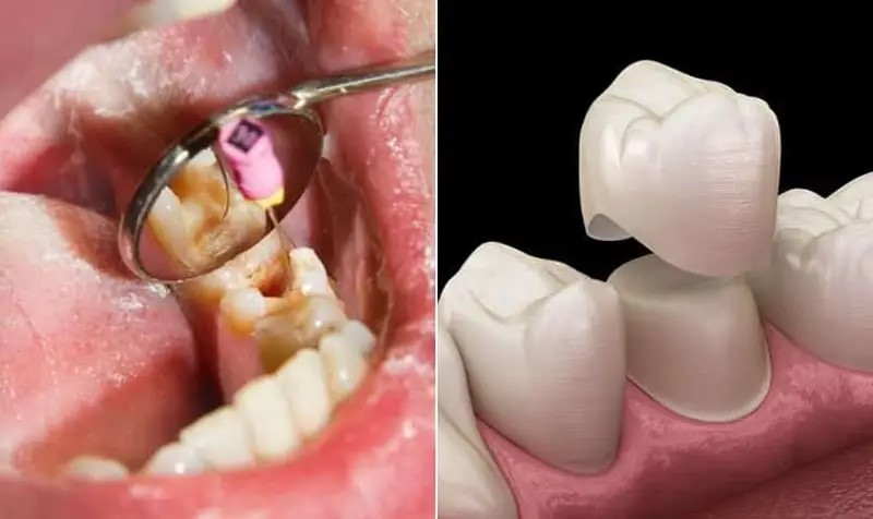 پیشگیری پوسیدگی دندان زیر روکش
